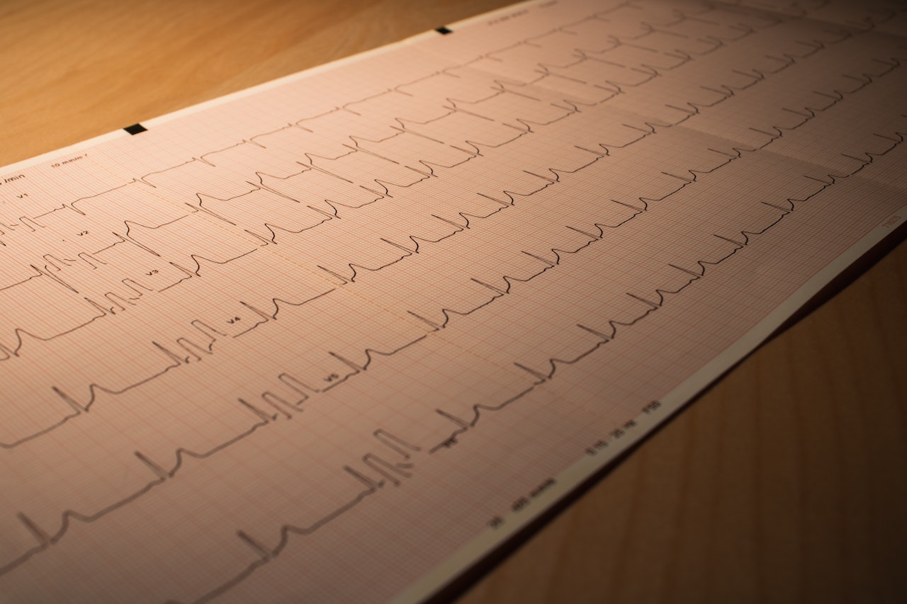 EKG Herzrhythmusstörung